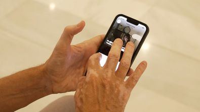 Según el primer 'Informe sobre el Vitíligo en el Entorno Digital', realizado por Incyte, las redes sociales se han convertido en un refugio para los pacientes.