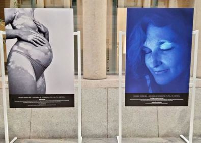 La muestra fotográfica que acoge el Ilustre Colegio Oficial de Médicos de Madrid, 'Tu piel, tu historia', pretende acercar a la ciudadanía la realidad de las personas que conviven con esta enfermedad.