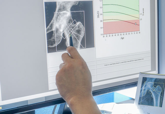 Con el fin de averiguar si los pacientes con EII presentan mayor riesgo de fractura osteoporótica, se está desarrollando un estudio prospectivo con 100 pacientes (50 de ellos con EII y otros 50, sin dicha enfermedad).