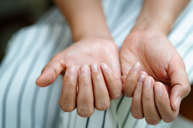 Tal y como señala el Dr. Jiménez Cauhé, “las enfermedades de las uñas son más frecuentes de lo que se cree y su tratamiento supone, sin duda, una mejora considerable en la calidad de vida de los pacientes”.